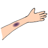 Bruise clipart #12, Download drawings
