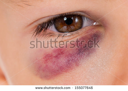 Bruise clipart #17, Download drawings